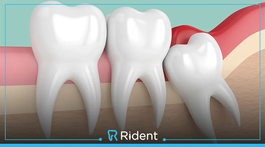 ضرس العقل المدفون و7 مضاعفات قد يسببها احذر منها Rident