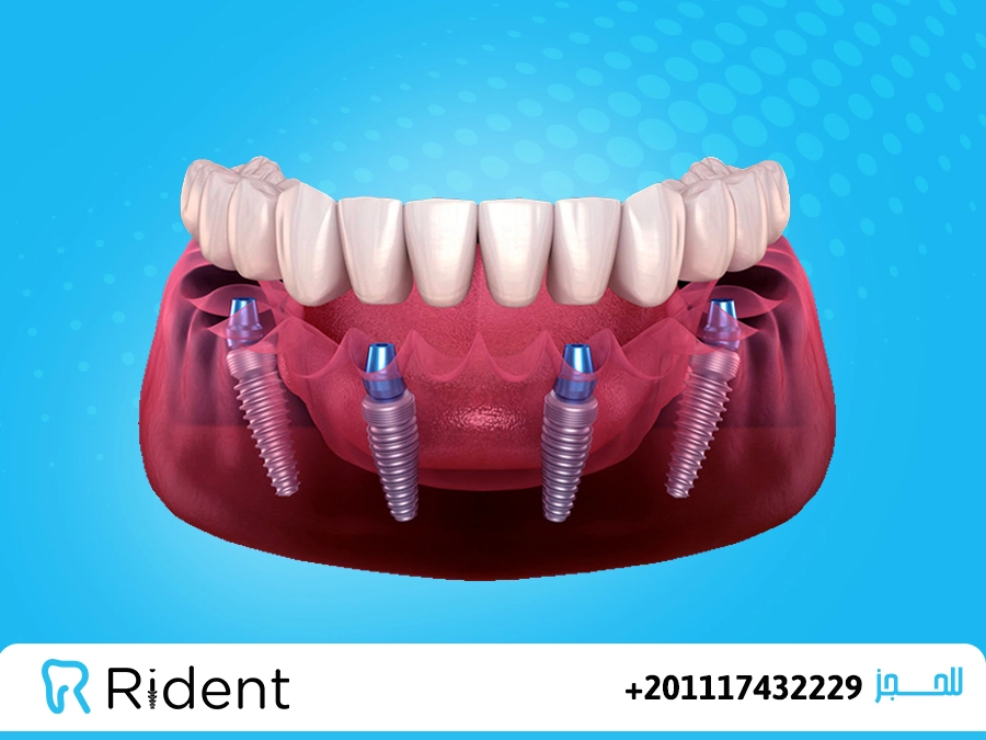 زراعة الأسنان all on 4