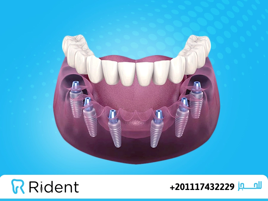 زراعة الأسنان all on 6 1 زراعة الأسنان all on 6
