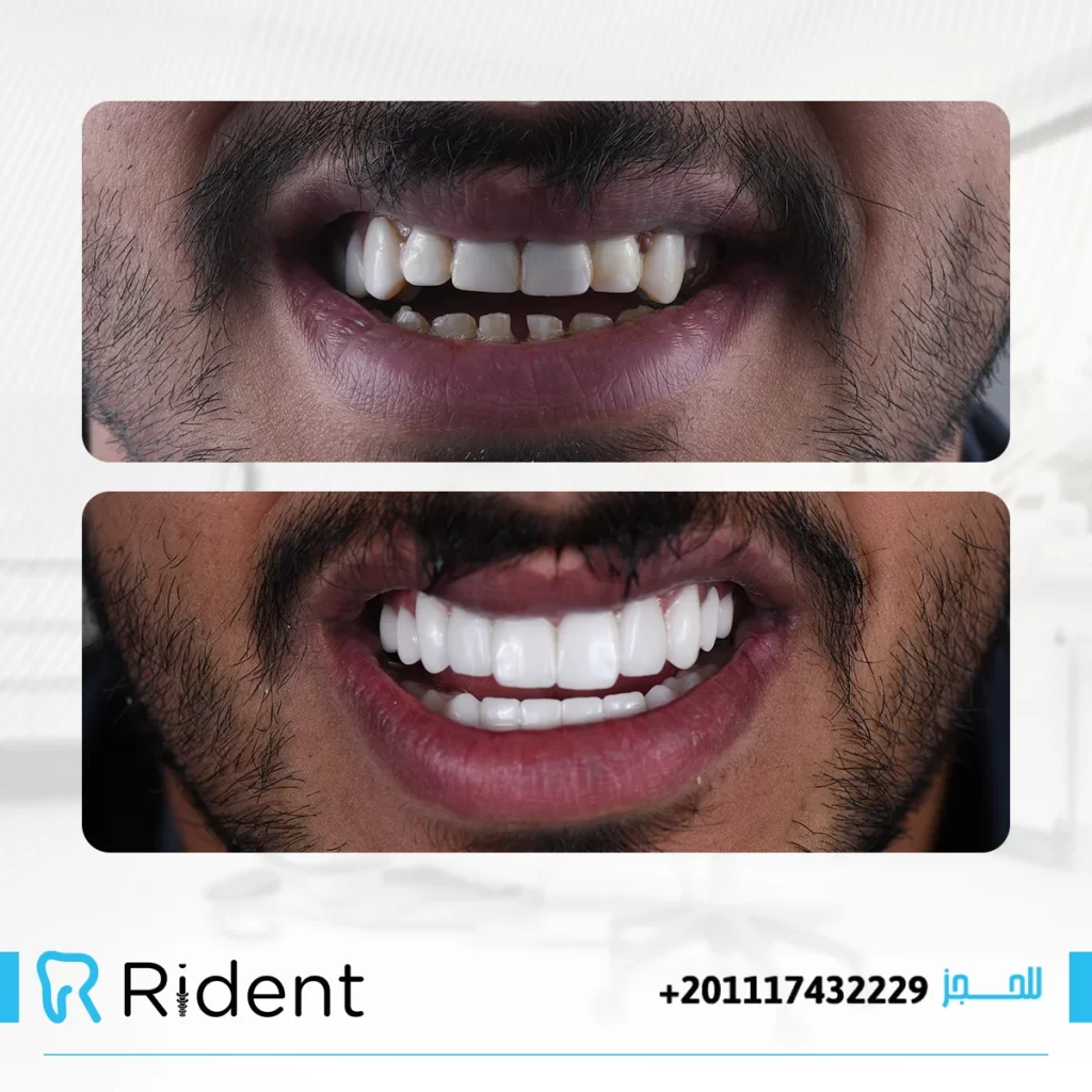 زراعة الاسنان 3 زراعة الاسنان