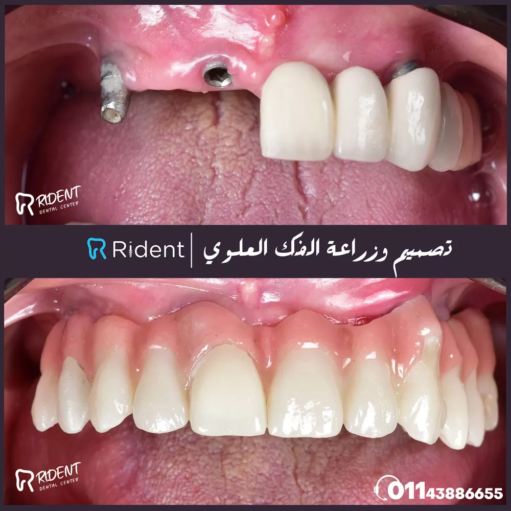 زراعة الأسنان (غرسات الأسنان) 2 %D8%B2%D8%B1%D8%A7%D8%B9%D8%A9 %D8%A7%D9%84%D8%A3%D8%B3%D9%86%D8%A7%D9%86 BA.jpg
