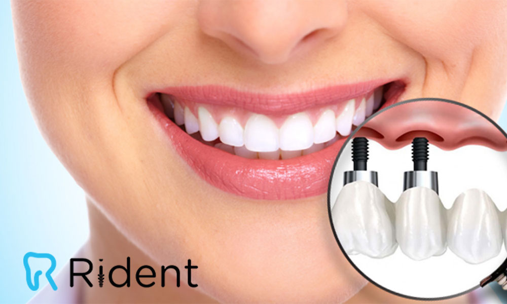 زراعة الأسنان (غرسات الأسنان) 3 زرع