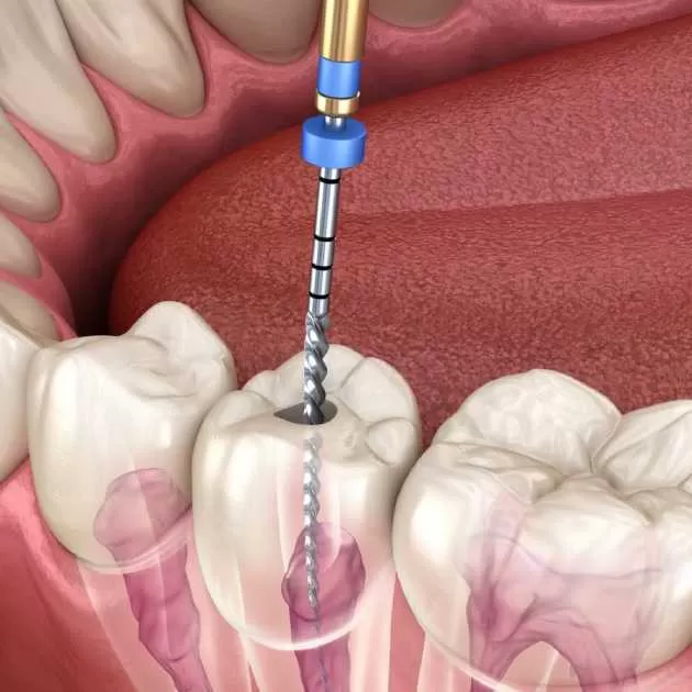 دليلك الشامل عن حشو العصب وتكلفته 2024 1 %D8%B3%D8%B9%D8%B1 %D8%AD%D8%B4%D9%88 %D8%A7%D9%84%D8%B9%D8%B5%D8%A8 1.jpg