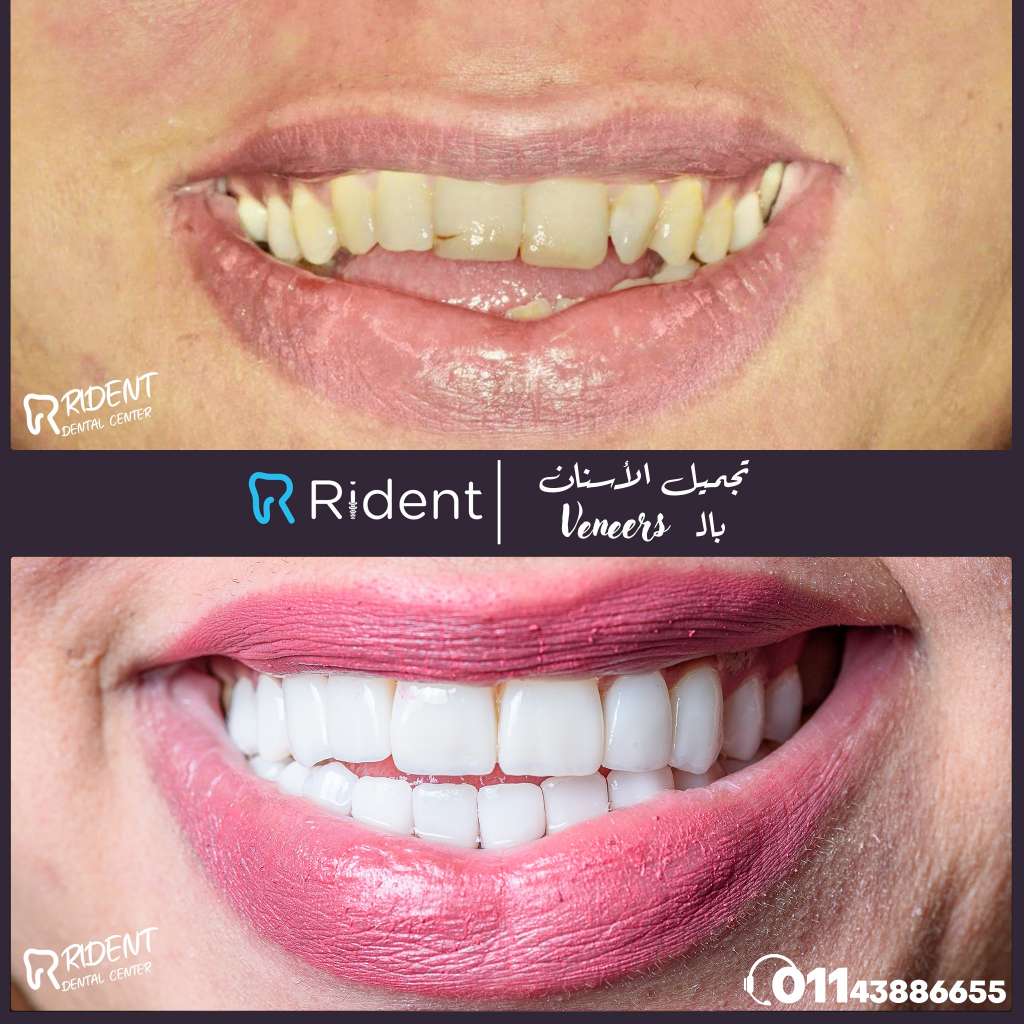 هل الفينير يحتاج إلى برد الأسنان؟ الإجابة في 70 ثانية 1 هل