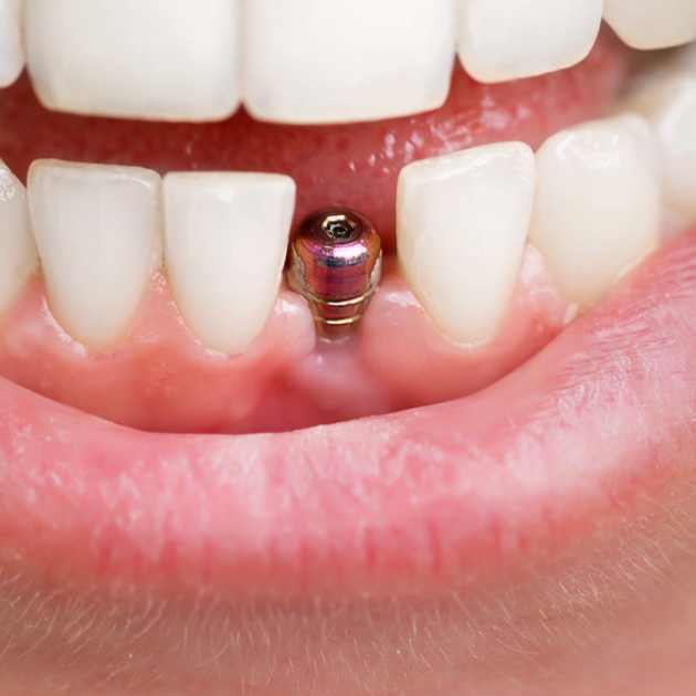 هل زراعة الاسنان مؤلمة؟ 1 هل