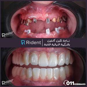 دليلك لأختيار أفضل انواع زراعة الاسنان 1 انواع