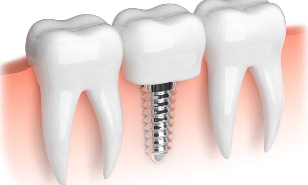 هل زراعة الاسنان مؤلمة؟ 2 أنواع زراعة الأسنان واسعارها