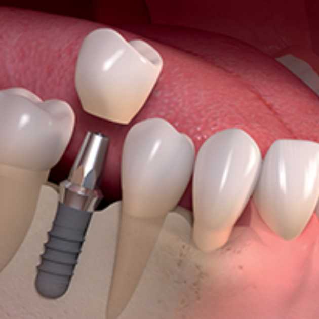 هل يمكن زراعة الاسنان بعد الخلع مباشرة أم بعد 4 أسابيع؟ 2 زراعة الاسنان بعد الخلع مباشرة