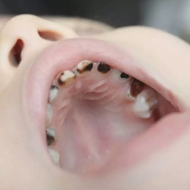 9 تساؤلات عن الاسنان اللبنية تهم كل أم 3 %D8%AA%D8%B3%D9%88%D8%B3 %D8%A7%D9%84%D8%A3%D8%B3%D9%86%D8%A7%D9%86 %D8%B9%D9%86%D8%AF %D8%A7%D9%84%D8%A3%D8%B7%D9%81%D8%A7%D9%84.jpg