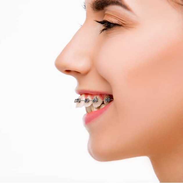 مدة تقويم الأسنان البارزة