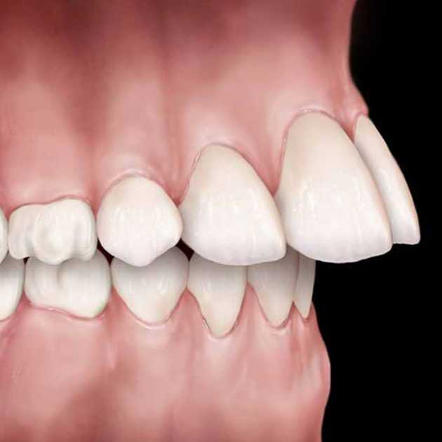 مدة تقويم الأسنان البارزة