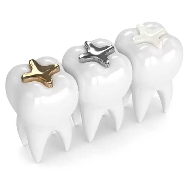 حشو الاسنان لعلاج التسوس والتآكل في 7 خطوات 1 %D8%AD%D8%B4%D9%88 %D8%A7%D9%84%D8%A7%D8%B3%D9%86%D8%A7%D9%86 1.jpg