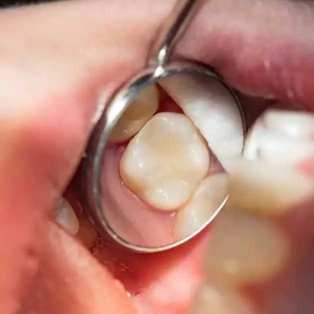 حشو الاسنان لعلاج التسوس والتآكل في 7 خطوات 2 %D8%AD%D8%B4%D9%88 %D8%A7%D9%84%D8%A7%D8%B3%D9%86%D8%A7%D9%86 3.jpg
