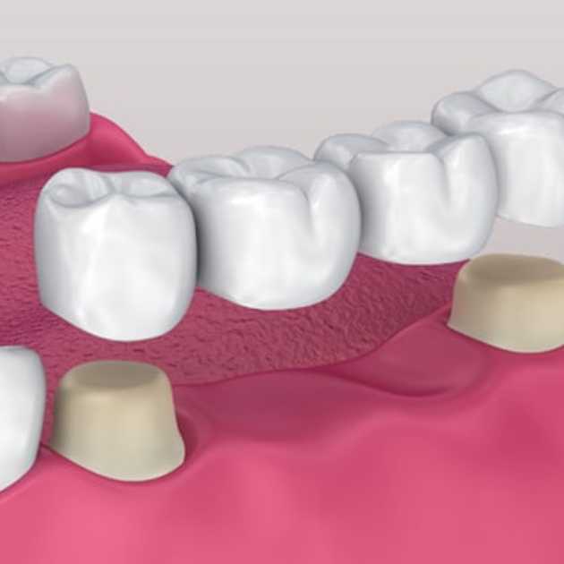 بدائل طربوش الأسنان .. 5 بدائل وما الأفضل من بينها؟ 2 بدائل طربوش الأسنان