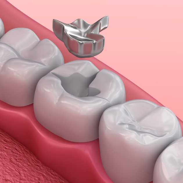حشو الاسنان