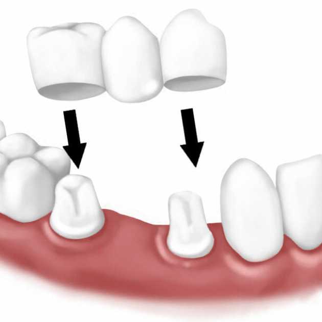 بدائل زراعة الأسنان