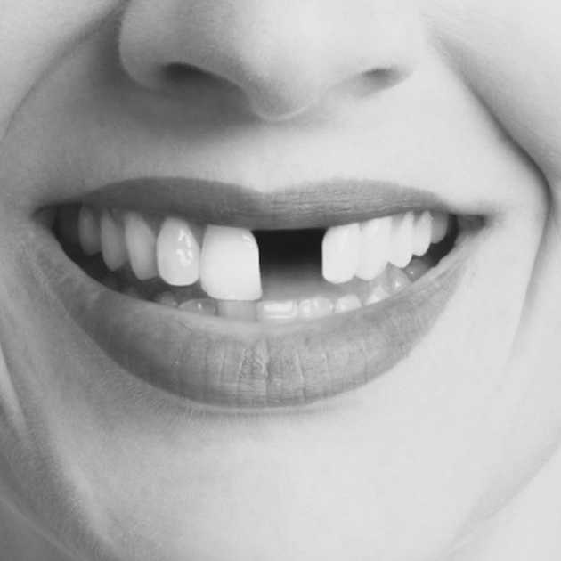 تركيب الأسنان الأمامية في 4 خطوات فقط 1 تركيب