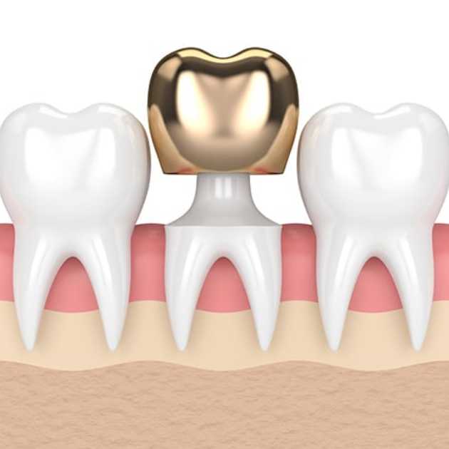 5 مميزات لـ تركيبات الاسنان وما الأضرار المحتملة؟ 3 تركيبات