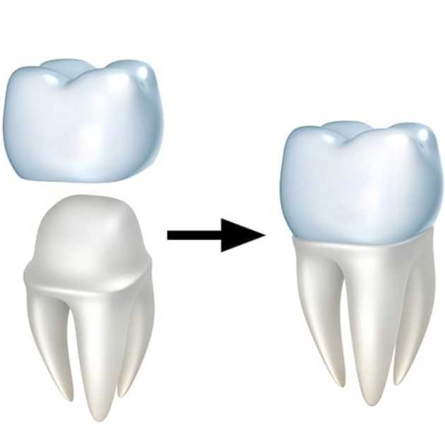 متى تحتاج لـ طربوش اسنان؟ وطريقة تركيبه في 6 خطوات 3 طربوش