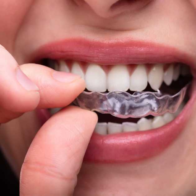 أنواع واقي الأسنان الليلي و6 نصائح للعناية به 2 واقي الأسنان الليلي (1)