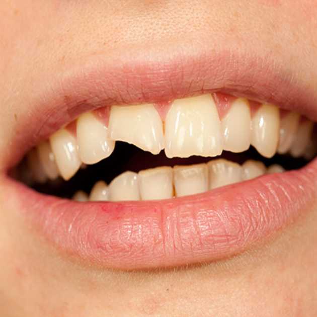 أسباب كسر الاسنان وعلاجه بـ 5 طرق مختلفة 1 كسر الاسنان (1)