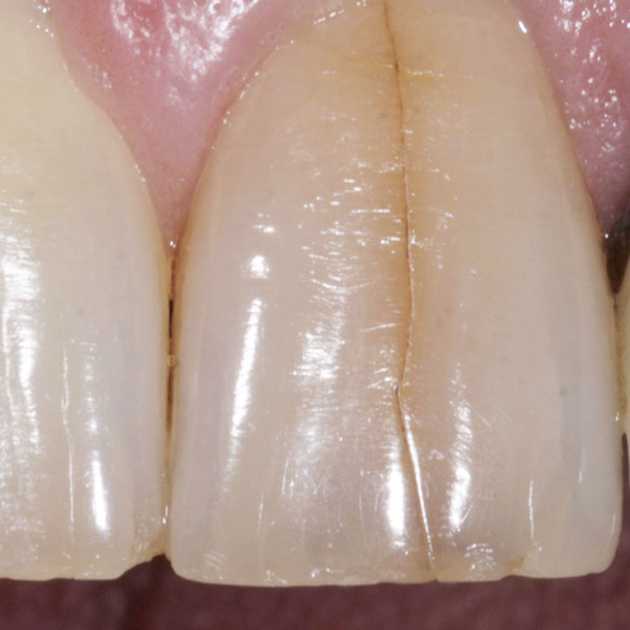 أسباب كسر الاسنان وعلاجه بـ 5 طرق مختلفة 3 كسر الاسنان (2)