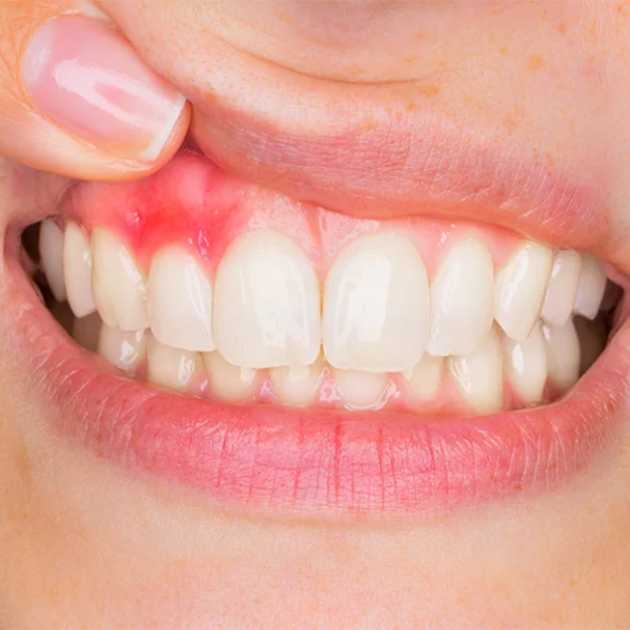 أنواع التهاب اللثة البسيط والشديد و8 طرق للعلاج 1 أنواع التهاب اللثة (1)