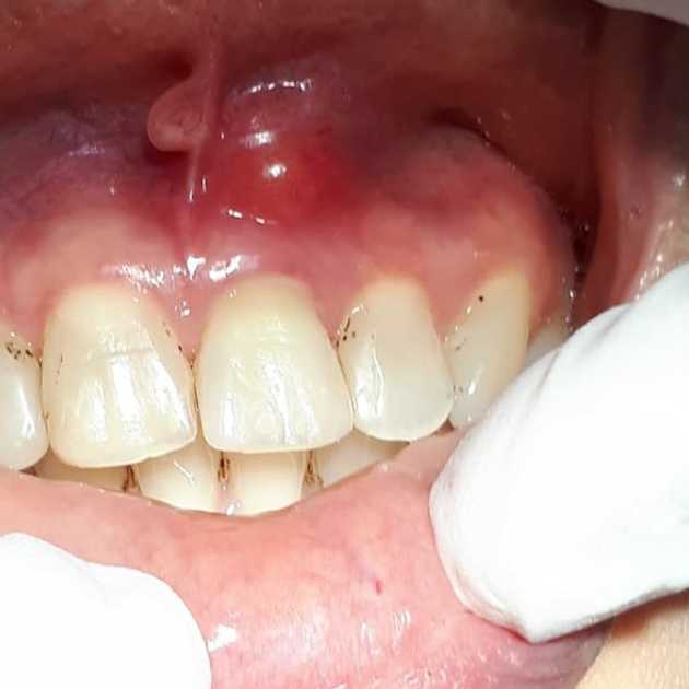 علاج خراج اللثة (1)