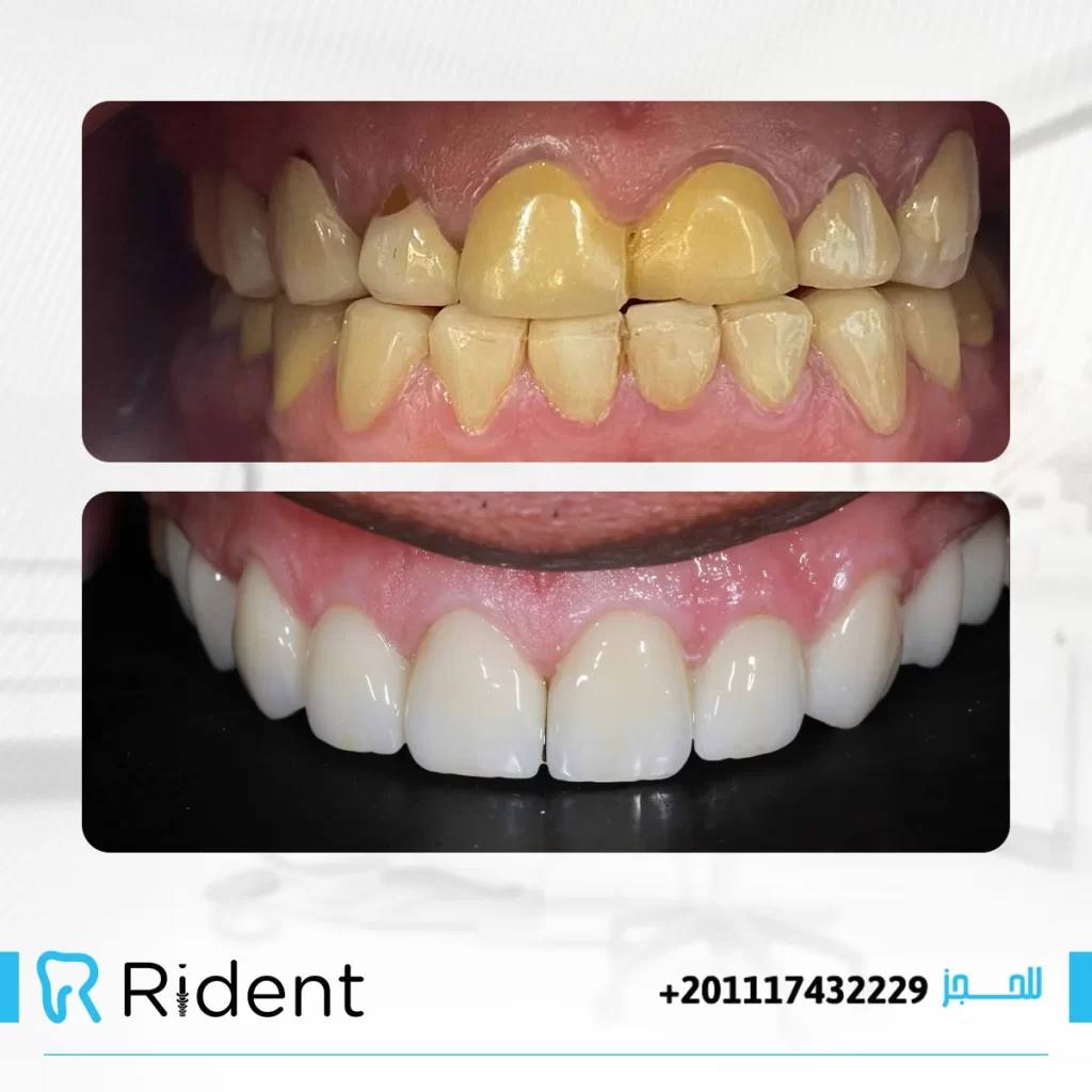 مراحل زراعة الاسنان 2 مراحل زراعة الاسنان