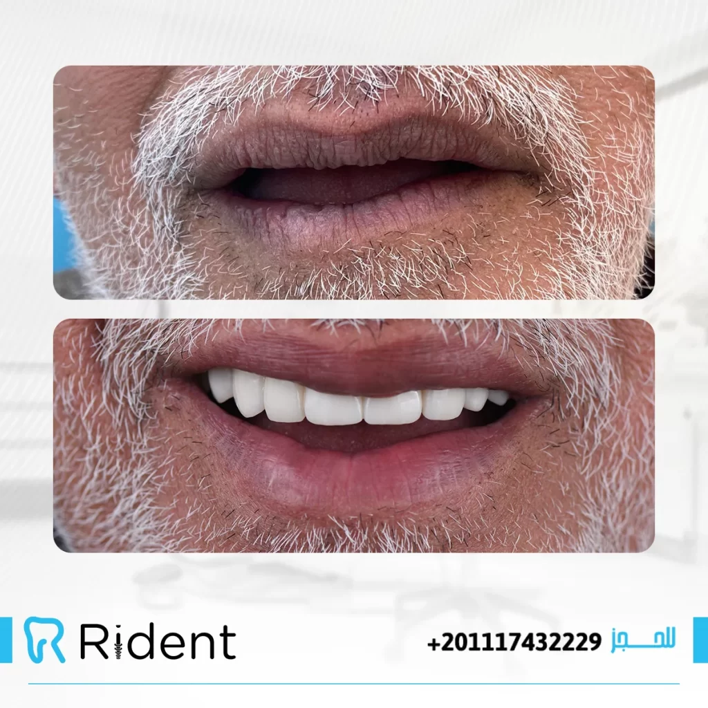 فوائد زراعة الاسنان واضرارها 1 فوائد زراعة الاسنان واضرارها