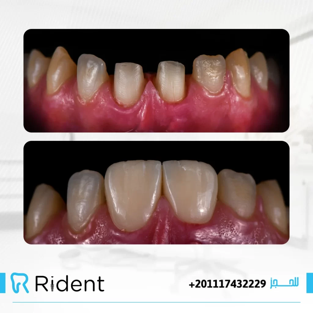 الفرق بين زراعة الأسنان الفورية والتقليدية 1 الفرق بين زراعة الأسنان الفورية والتقليدية