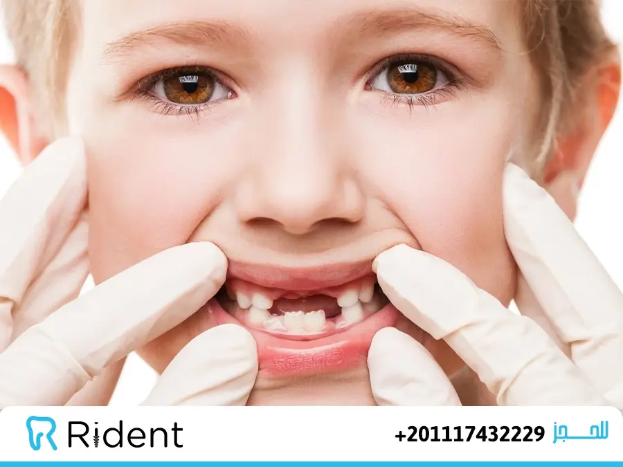 تسوس الاسنان عند الاطفال