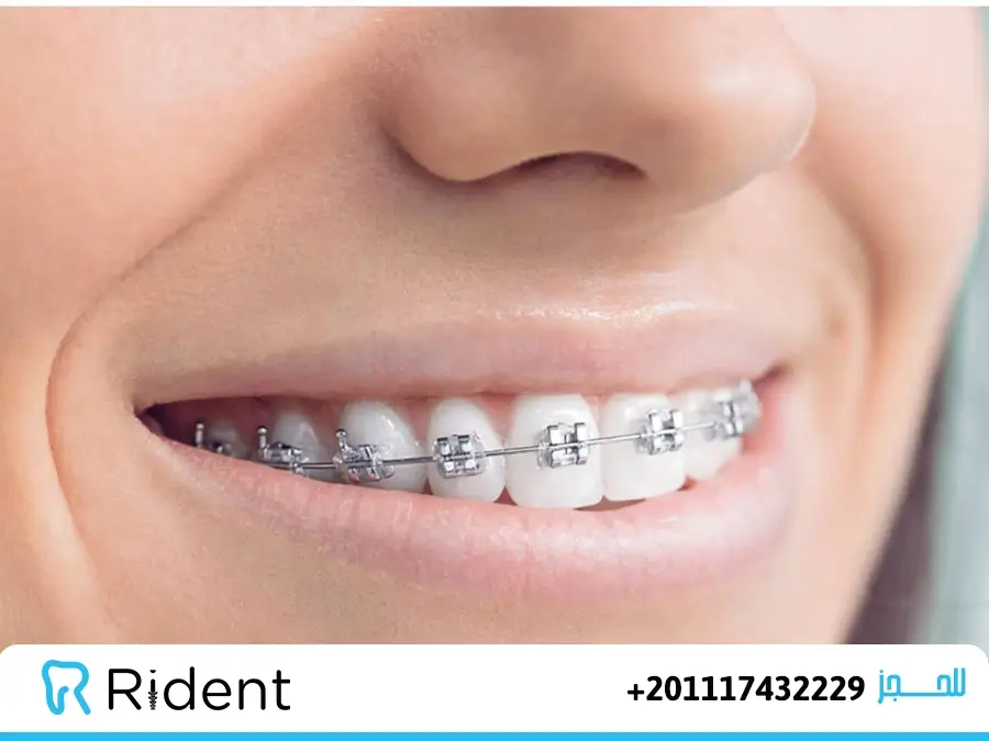 التقويم الشفاف