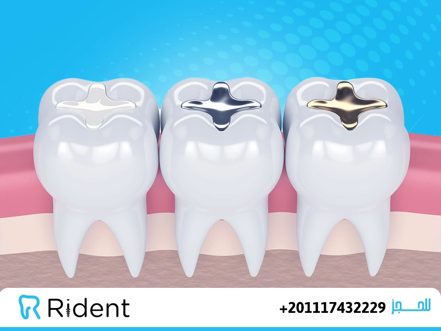 انواع حشو الاسنان