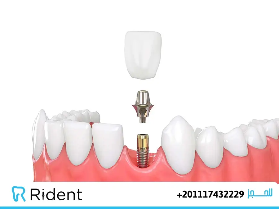 أسعار زراعة الأسنان في مصر