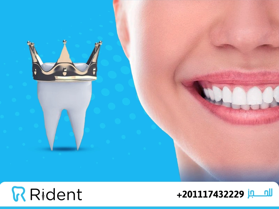 أفضل انواع تجميل الاسنان ايهما تناسبك ؟