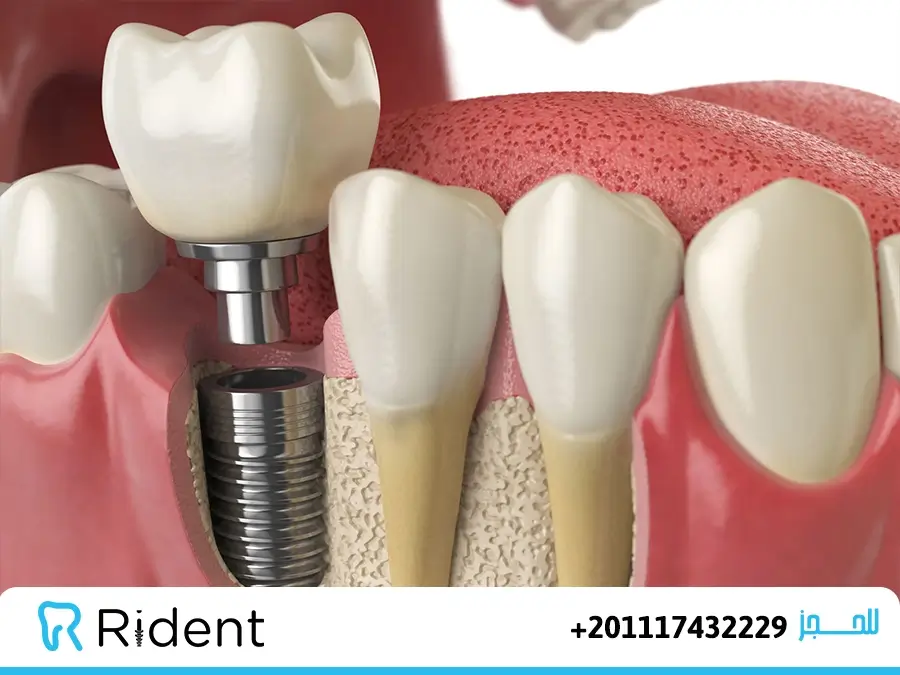 أنواع تركيبات الاسنان