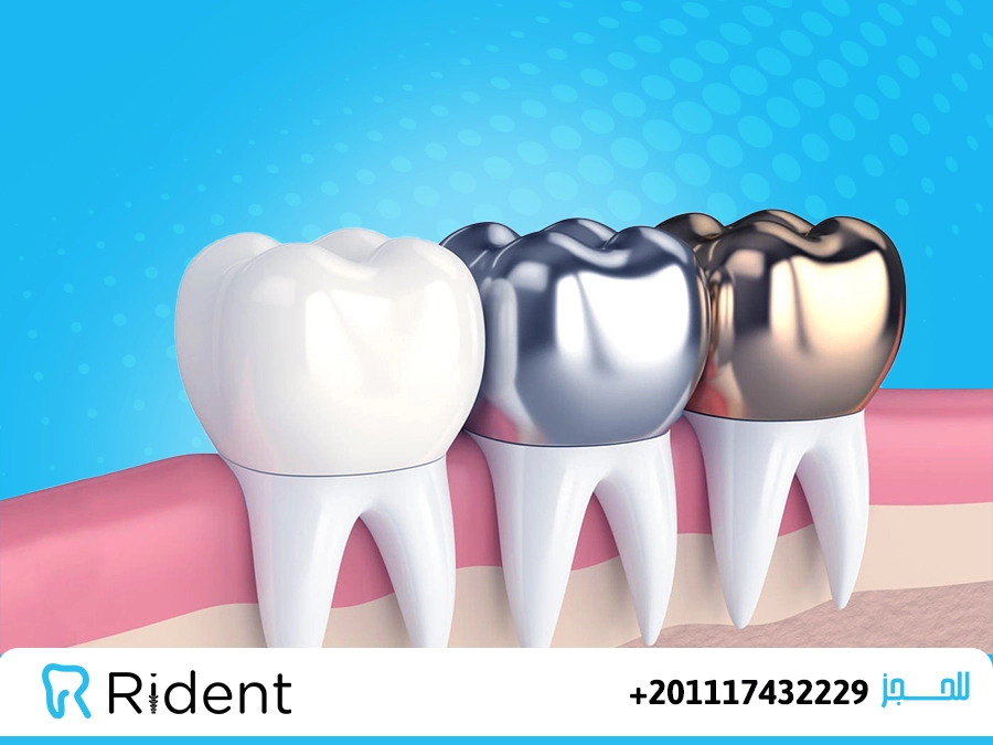 أنواع كراون الاسنان