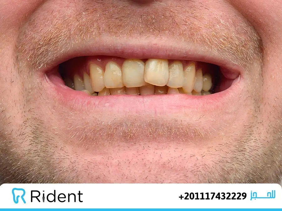 اسباب اصفرار الاسنان