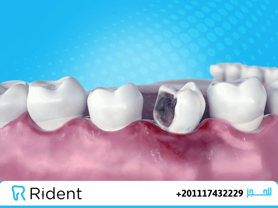 اسباب التهاب اللثة 1 من اسباب التهاب اللثة