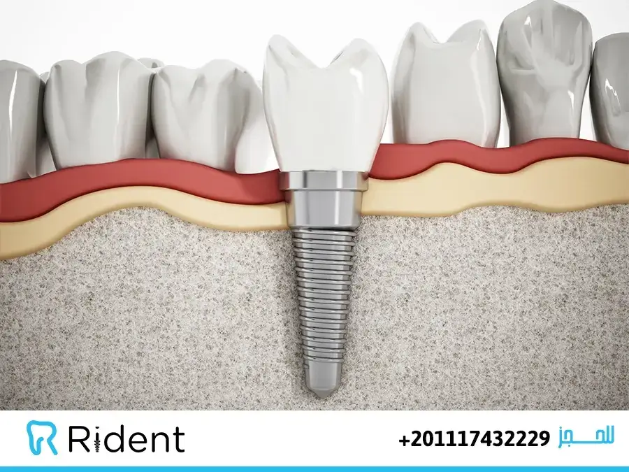 اسعار تركيب الاسنان