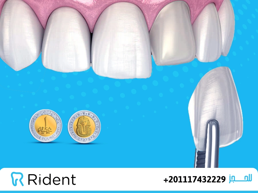 اسعار فينير الاسنان