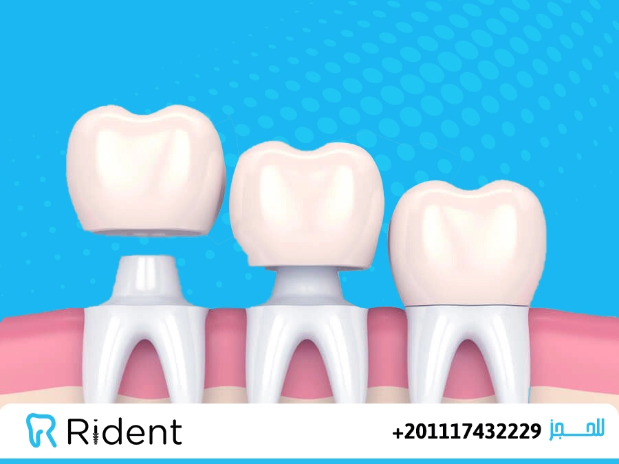 اسعار كراون الاسنان
