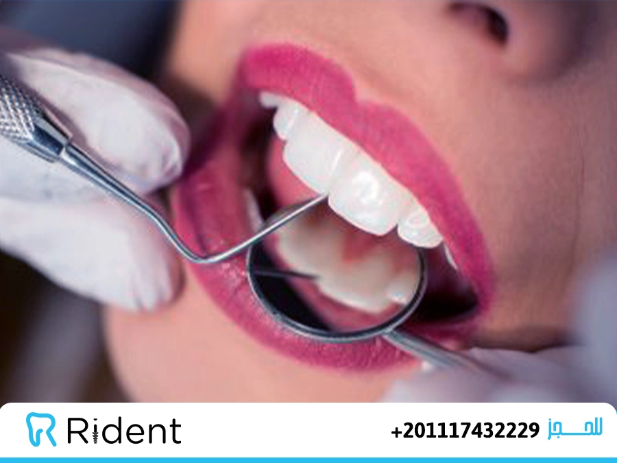 سعر كراون الاسنان