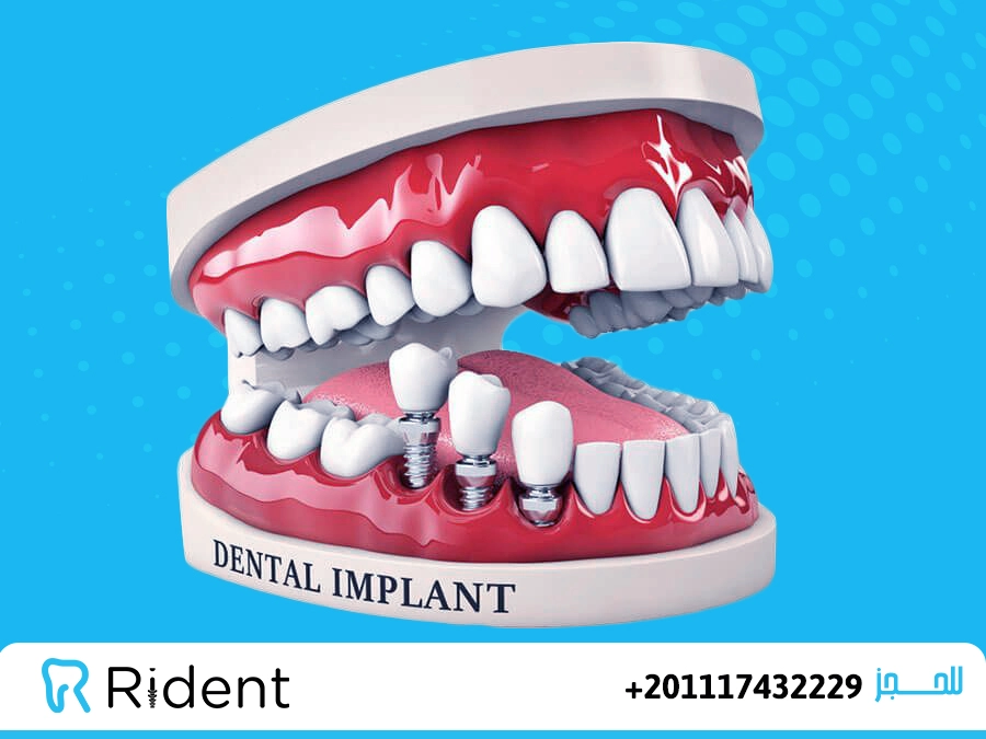افضل انواع تركيبات الاسنان الثابتة والمتحركة