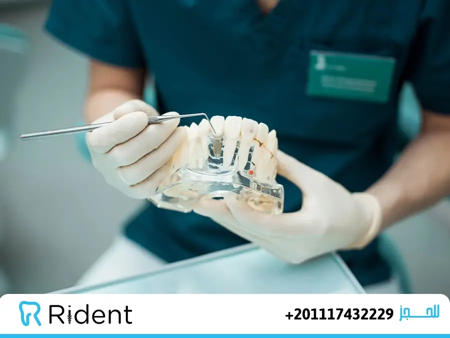 افضل دكتور زراعة اسنان