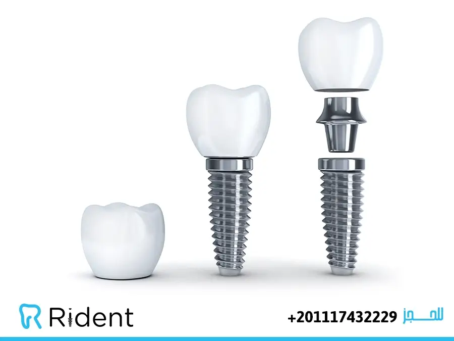 افضل مراكز زراعة الاسنان فى مصر