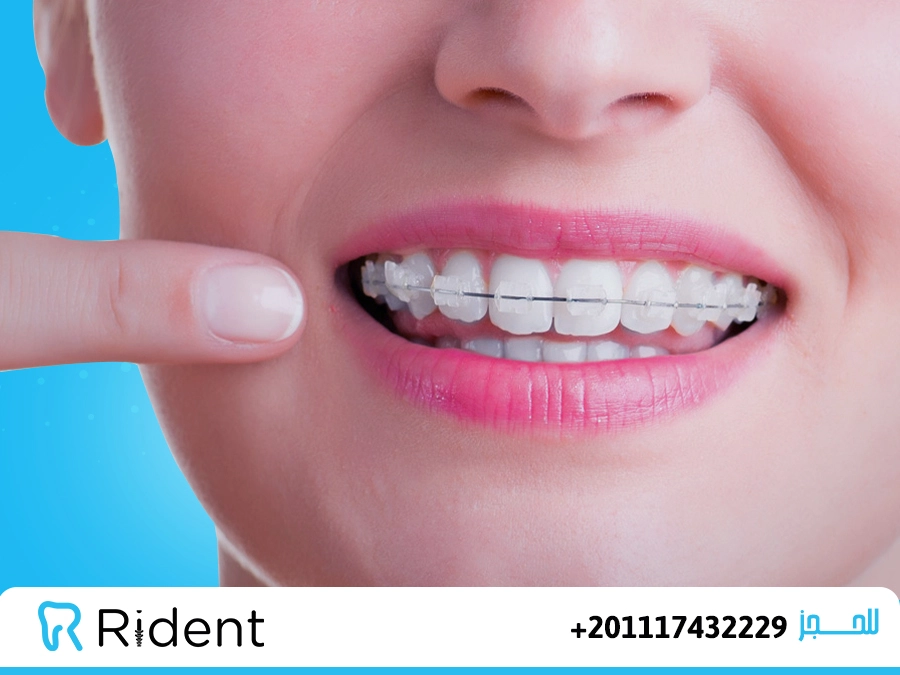 التقويم الشفاف للاسنان