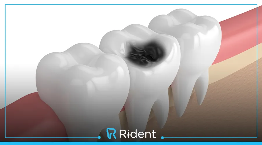 الضرس المسوس | الأسباب والأعراض والعلاج 1 الضرس المسوس