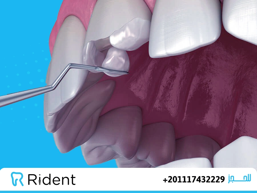 الفرق بين الفينير واللومينير